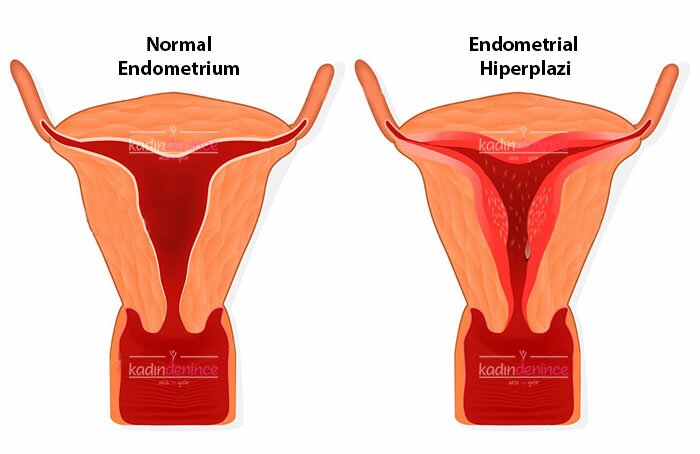 Rahim İç Tabakası Kalınlaşması (Endometrial Hiperplazi)