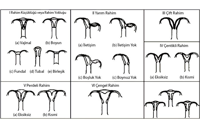 Konjenital Uterin Anomaliler (Rahimin Doğumsal Anomalileri) Konjenital Uterin Anomaliler (Rahimin Doğumsal Anomalileri)